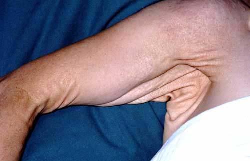 PSEUDOXANTHOMA ELASTICUM