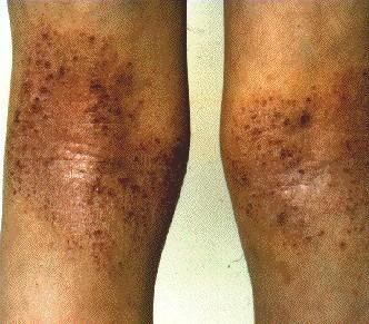 ATOPIC ECZEMA -ON LEGS