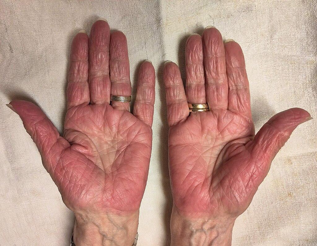 Photo of Palmar erythema