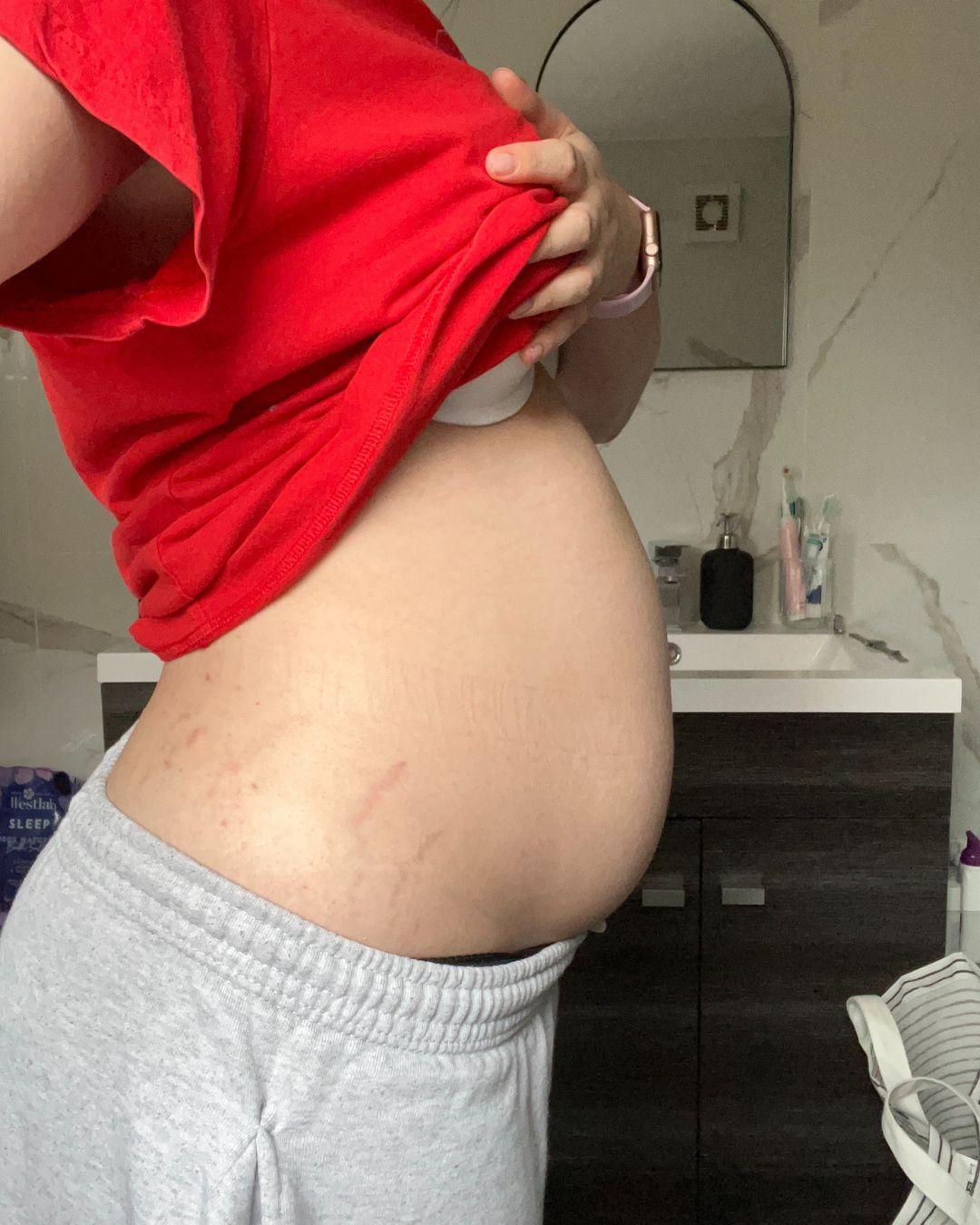 Photograph of a young woman holding up her t-shirt to show an abnormally bloated stomach.