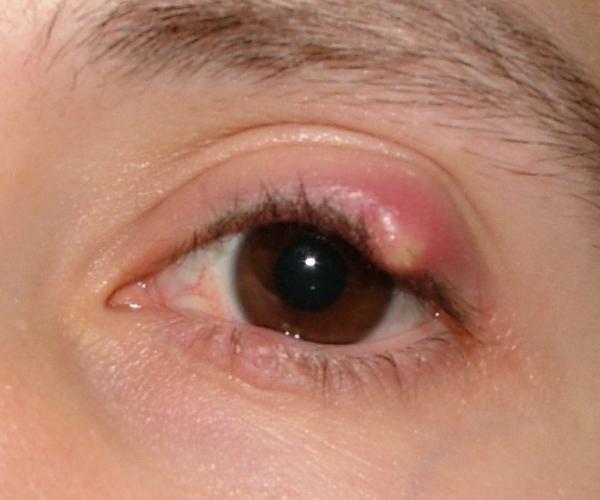 chalazion