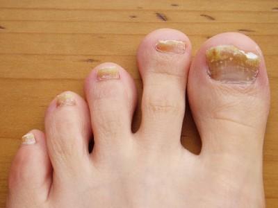 fungal nail infection