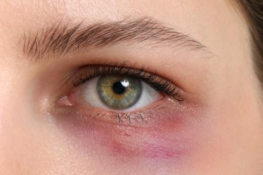 A close up of a women's black eye