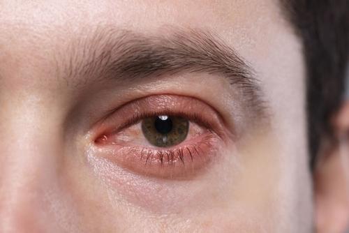 A close up of an eye with allergic onjunctivitis