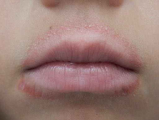 Lip-licking dermatitis