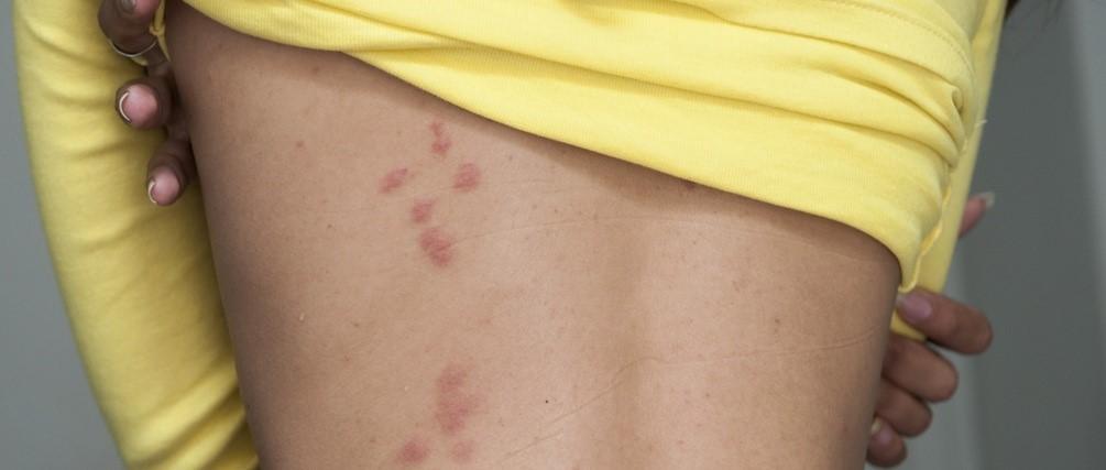 bedbug bite