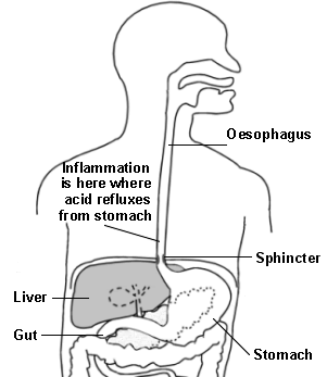Acid reflux inflammation