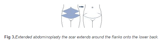 Extended abdominoplasty