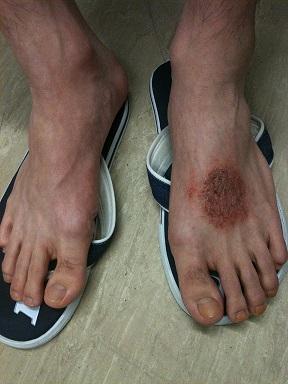 Lichen simplex on dorsum of foot of young man