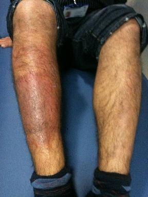 Lichen simplex on shin of young man