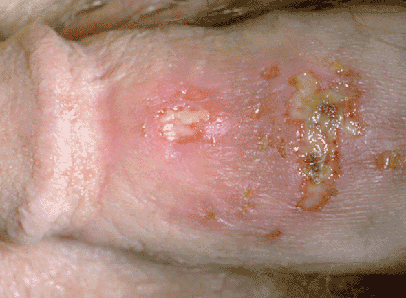 Lesions typical of a genital herpes in men