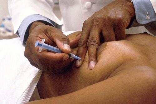 Fine-needle aspiration