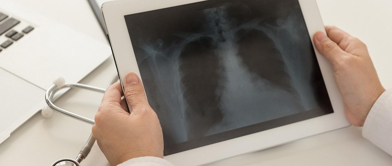 Chronic obstructive pulmonary disease