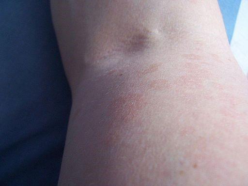 Pityriasis versicolor close-up