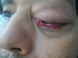 Periorbital cellulitis