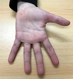 Scabies on hand and fingers