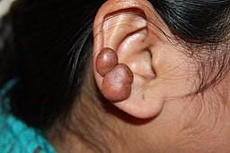 Keloid on ear