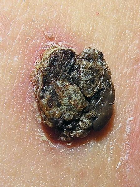 Seborrhoeic keratosis
