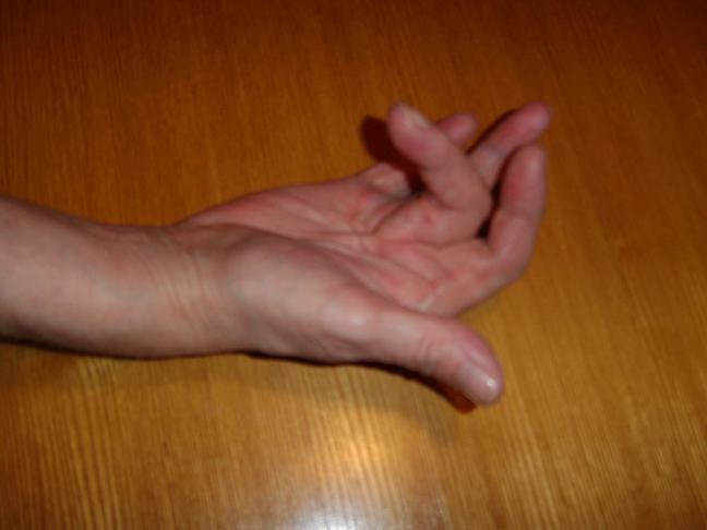 Dupuytren's contracture