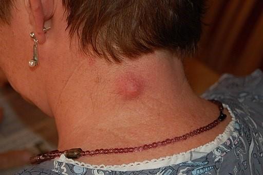Epidermoid cyst on the neck
