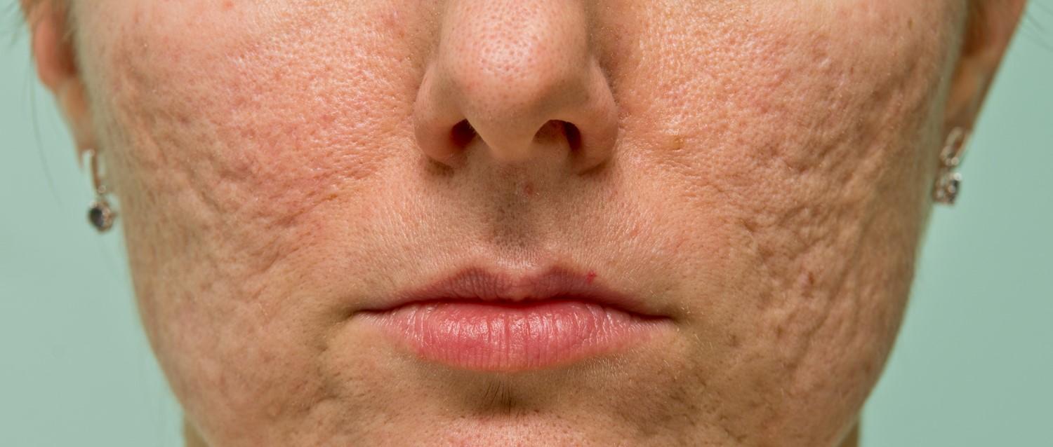 Does Bio-Oil help acne scars?