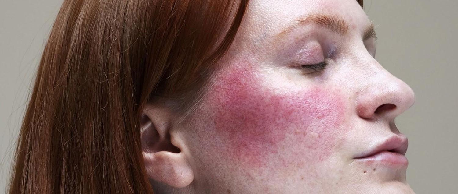 Rosacea treatments: which is right for you?