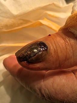 Thumb melanoma