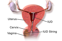 IUD