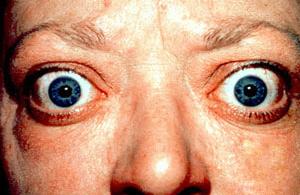 Thyroid eye disease before and after