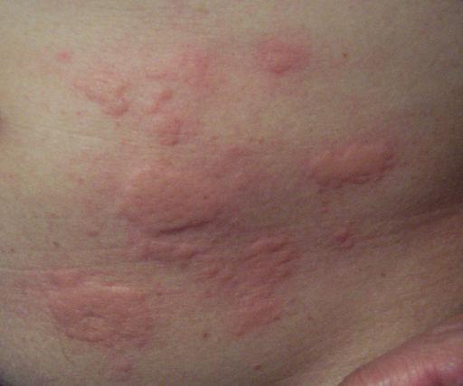 A picture of hives on a persons skin